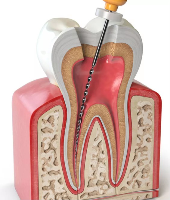 ENDODONTICS